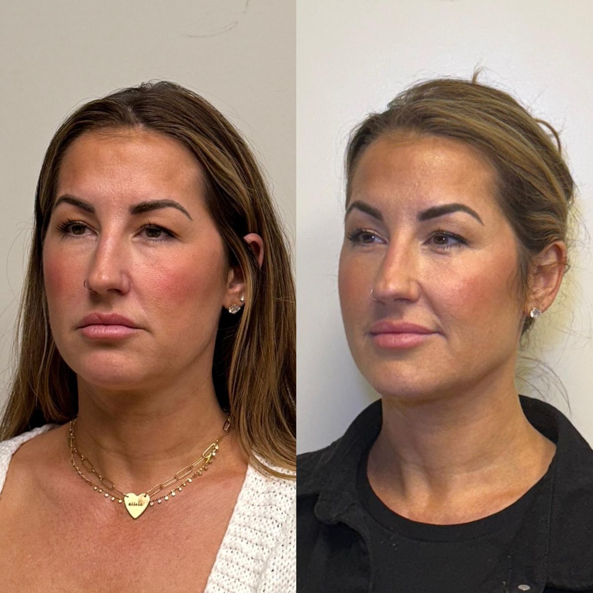 Before and after Facial Balancing at Aster Aesthetics Salem Oregon