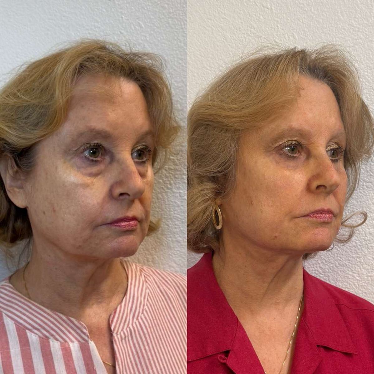 Before and after Facial Balancing at Aster Aesthetics Salem Oregon