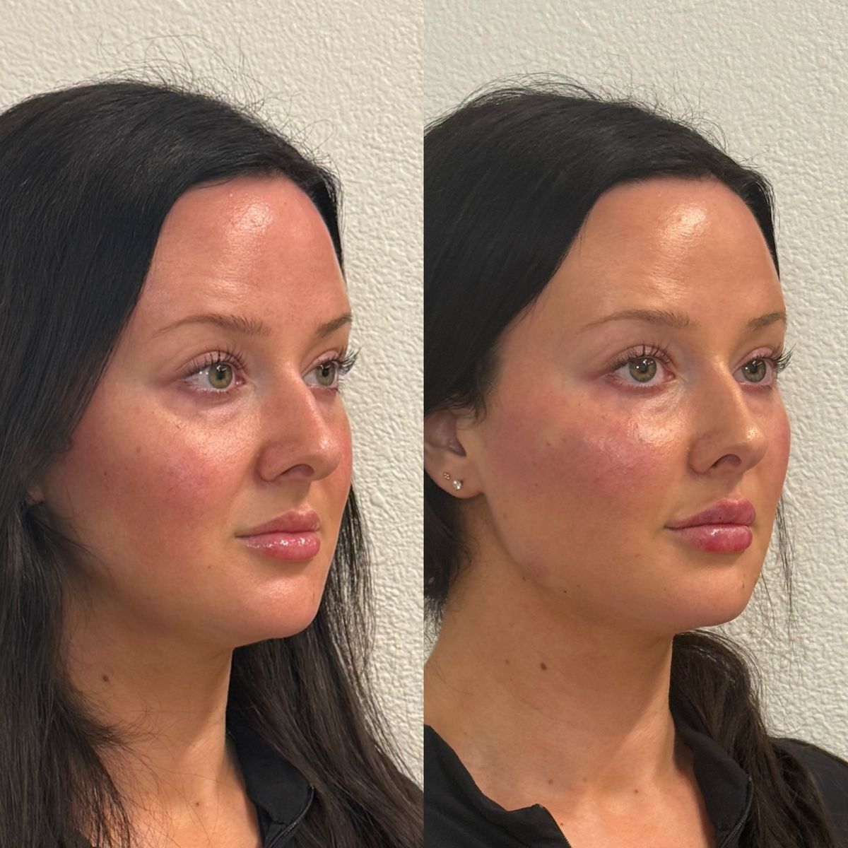 Before and after Facial Balancing at Aster Aesthetics Salem Oregon