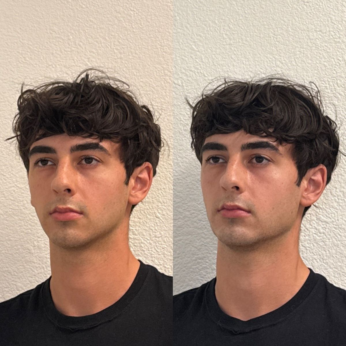 Before and after Facial Balancing at Aster Aesthetics Salem Oregon