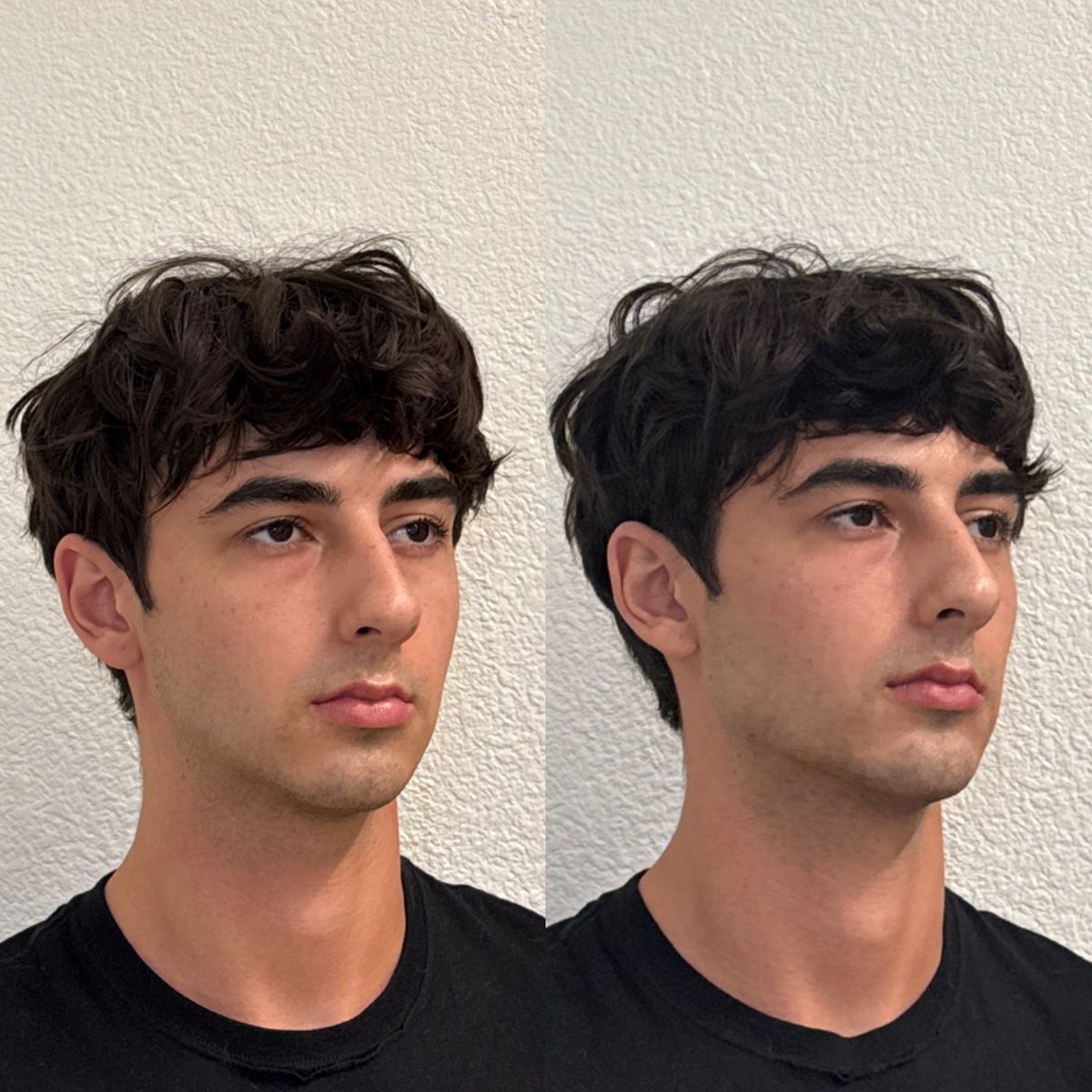 Before and after Facial Balancing at Aster Aesthetics Salem Oregon