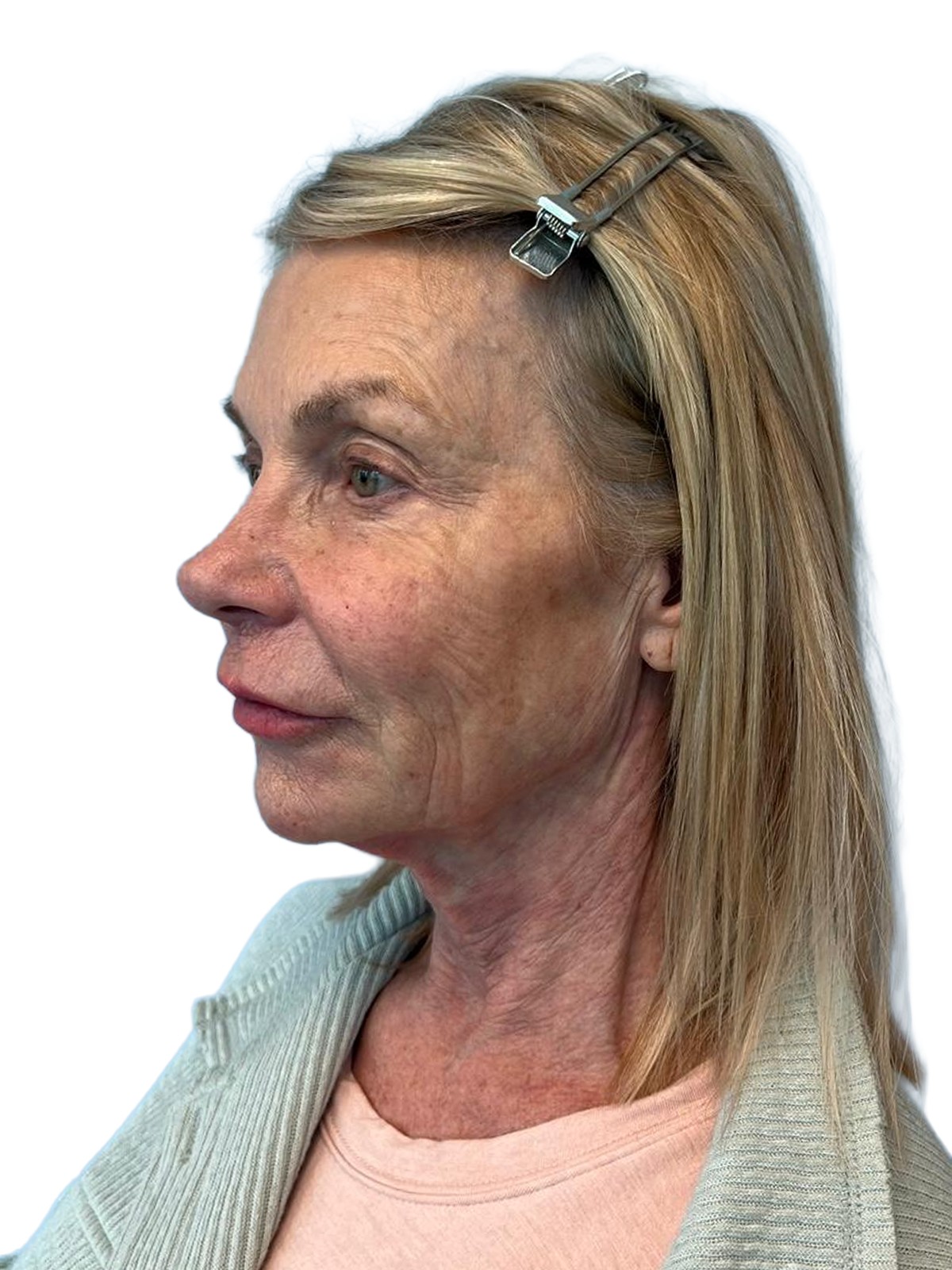 Before Treatment