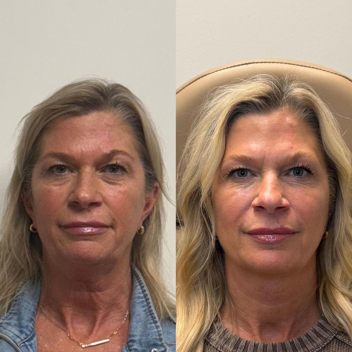 Before and after Facial Balancing — Healed Results at Aster Aesthetics Salem Oregon