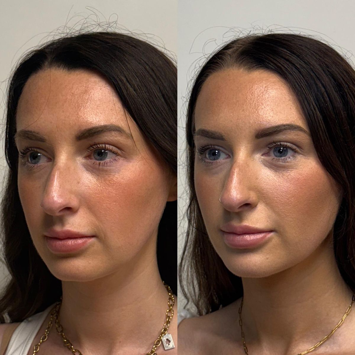 Before and after Facial Balancing — Healed Results at Aster Aesthetics Salem Oregon