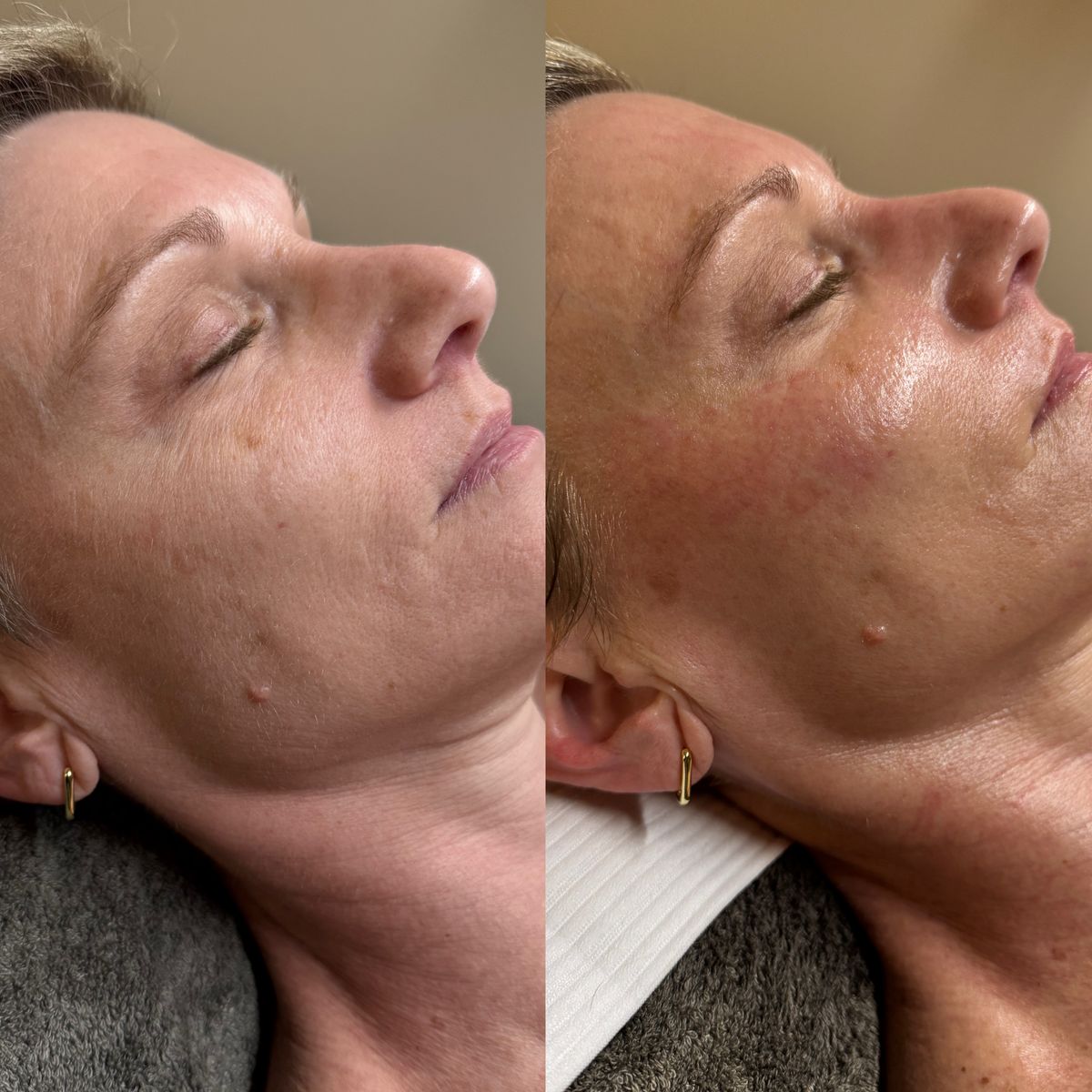 Before and after Before and After Aster Signature Facial at Aster Aesthetics Salem Oregon