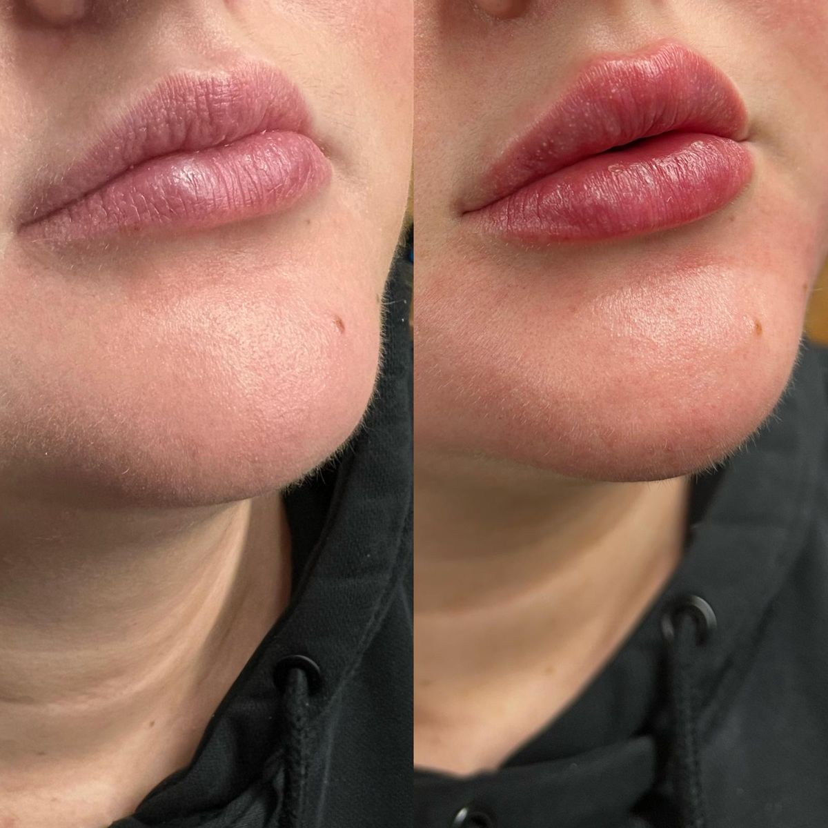 Before and after Maintenance Lip Filler at Aster Aesthetics Salem Oregon