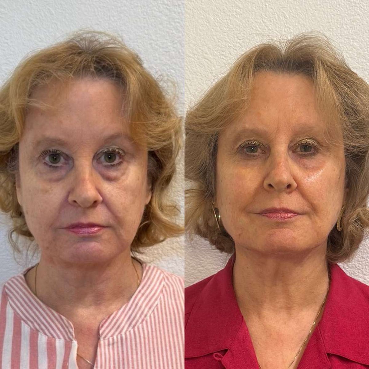 Before and after Facial Balancing at Aster Aesthetics Salem Oregon