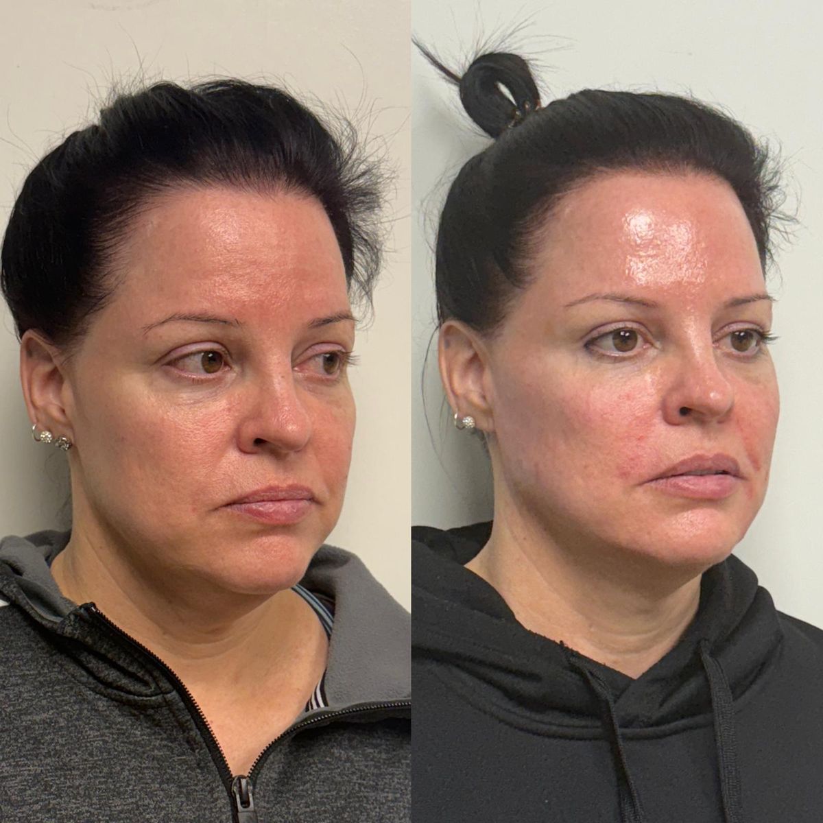Before and after Full Facial Balancing — Before & Immediately After at Aster Aesthetics Salem Oregon
