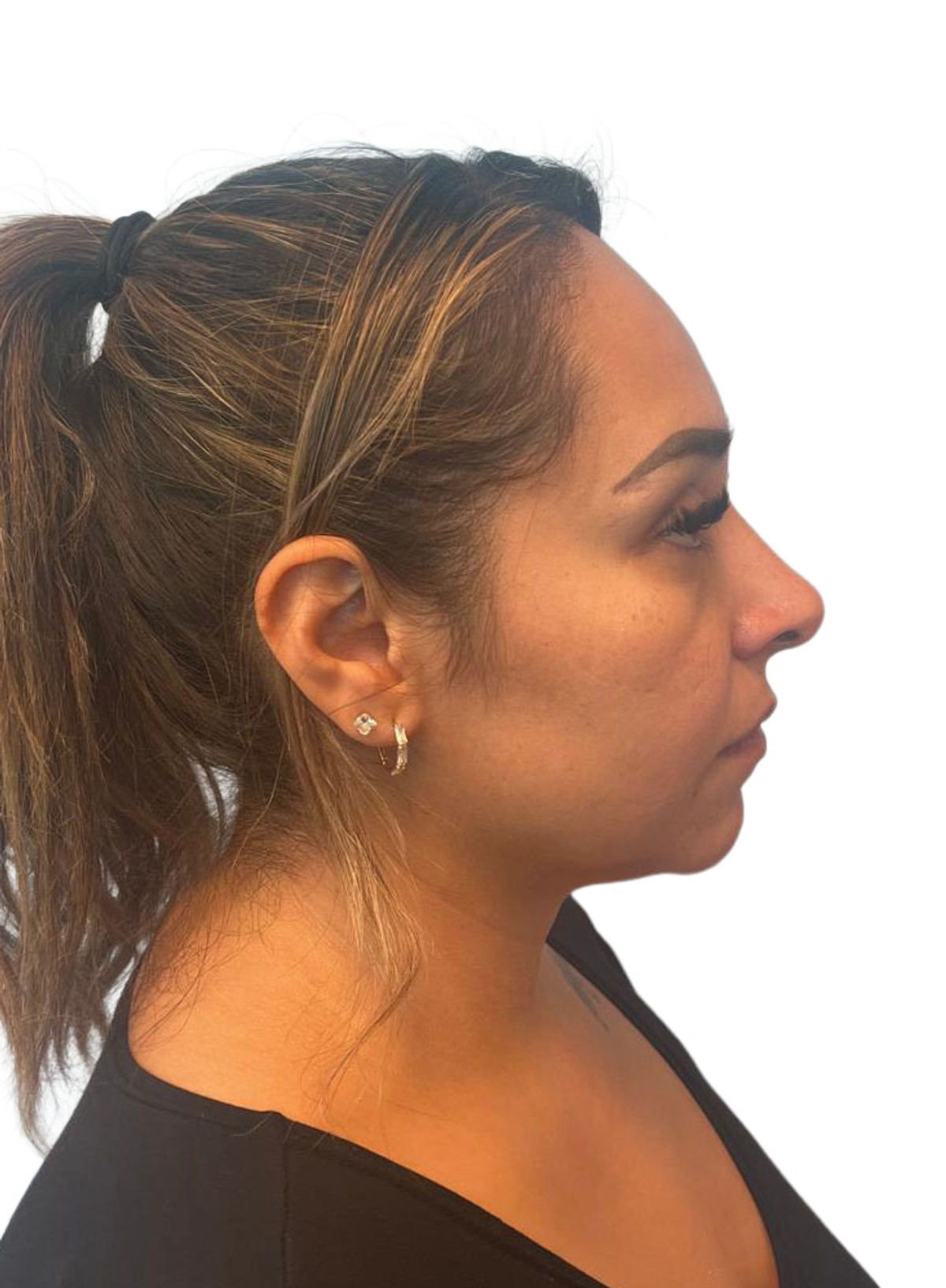 Before Treatment