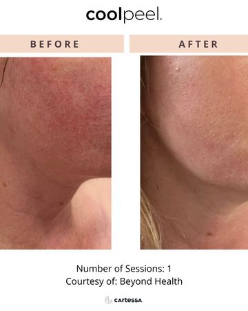 Cool Peel173444683519