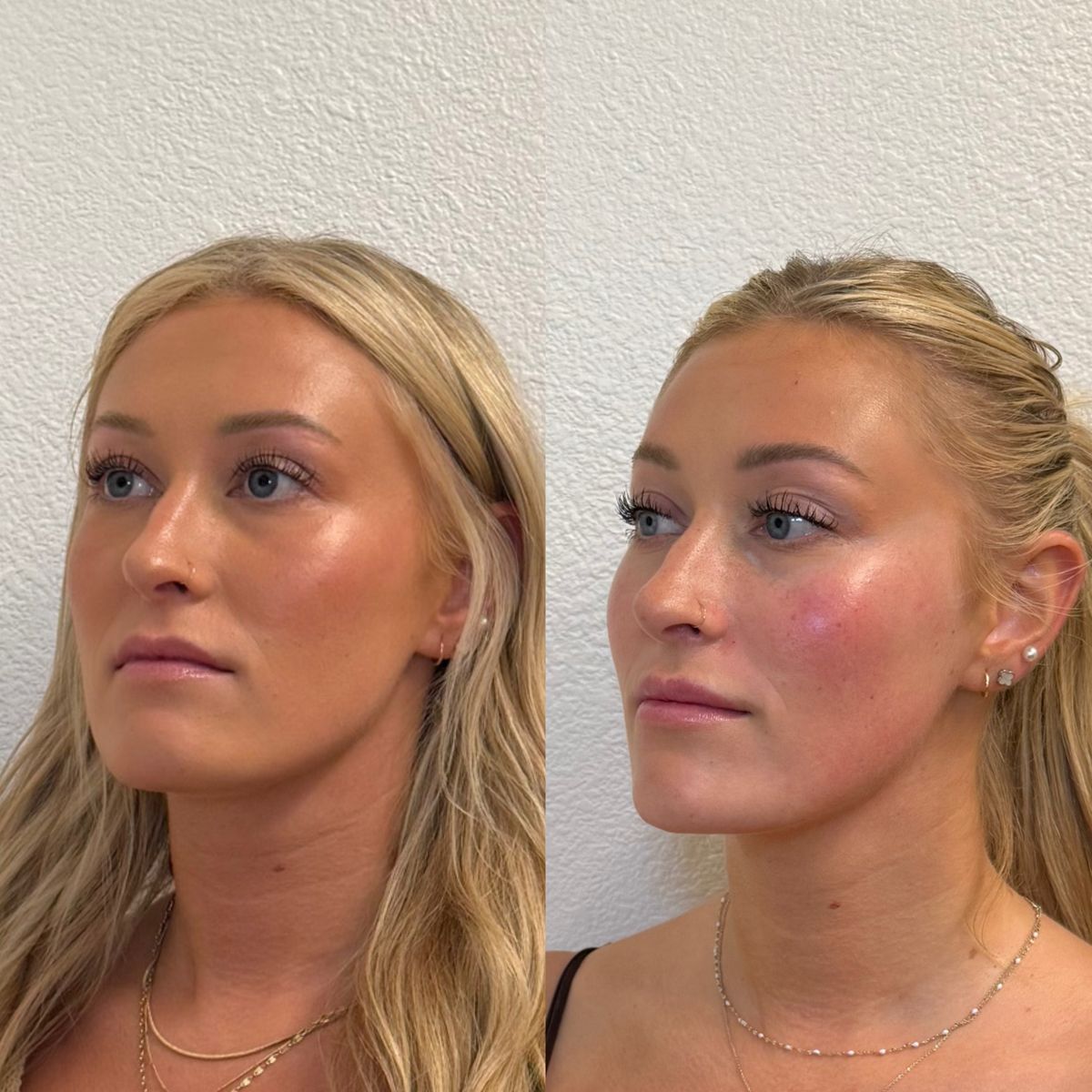 Before and after Immediately Before and After Facial Balancing at Aster Aesthetics Salem Oregon
