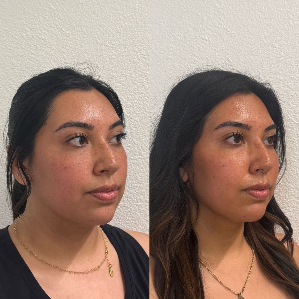 Before and after Facial Balancing at Aster Aesthetics Salem Oregon