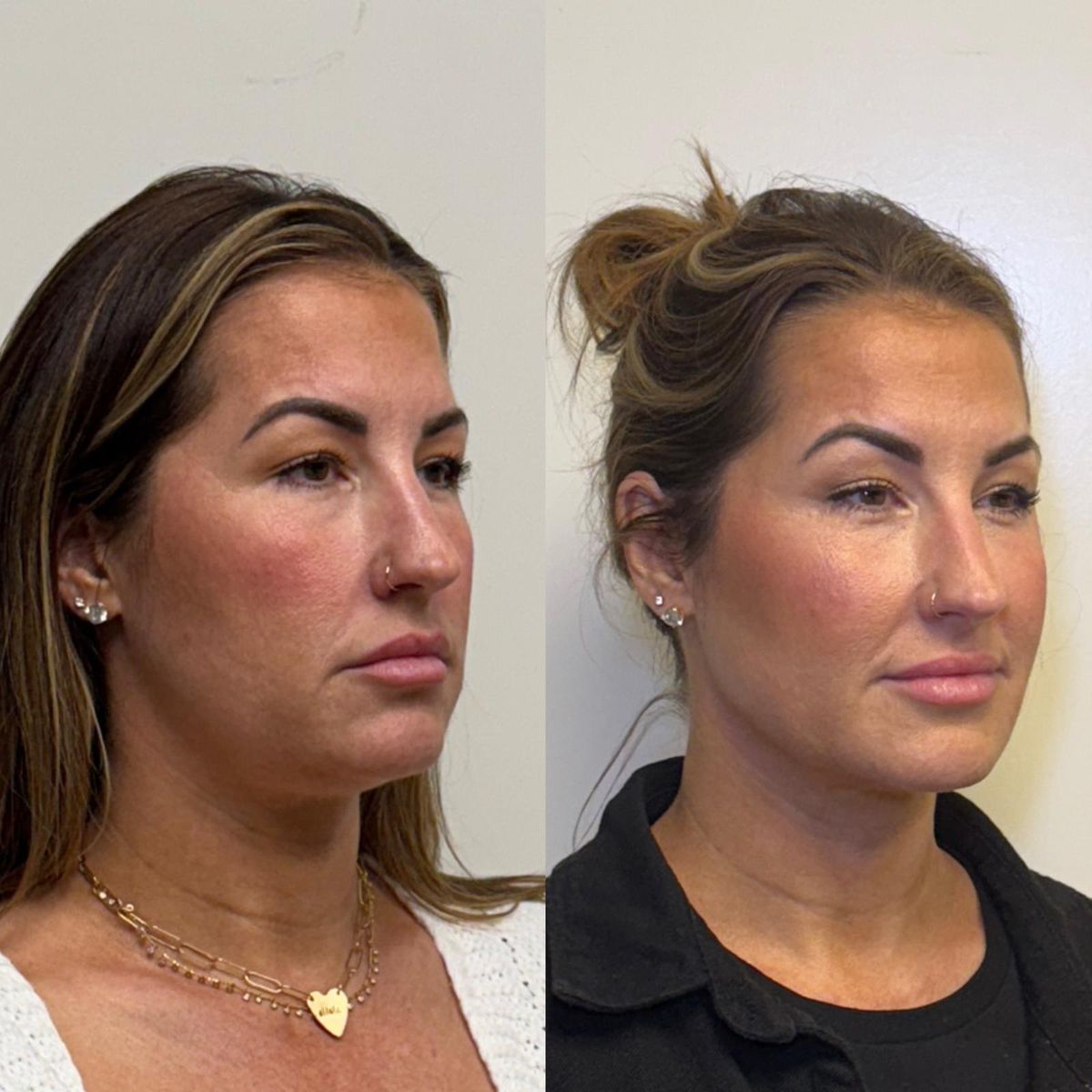 Before and after Facial Balancing at Aster Aesthetics Salem Oregon