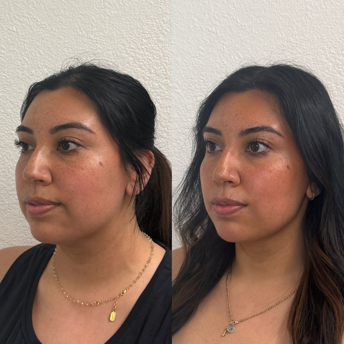 Before and after Facial Balancing at Aster Aesthetics Salem Oregon