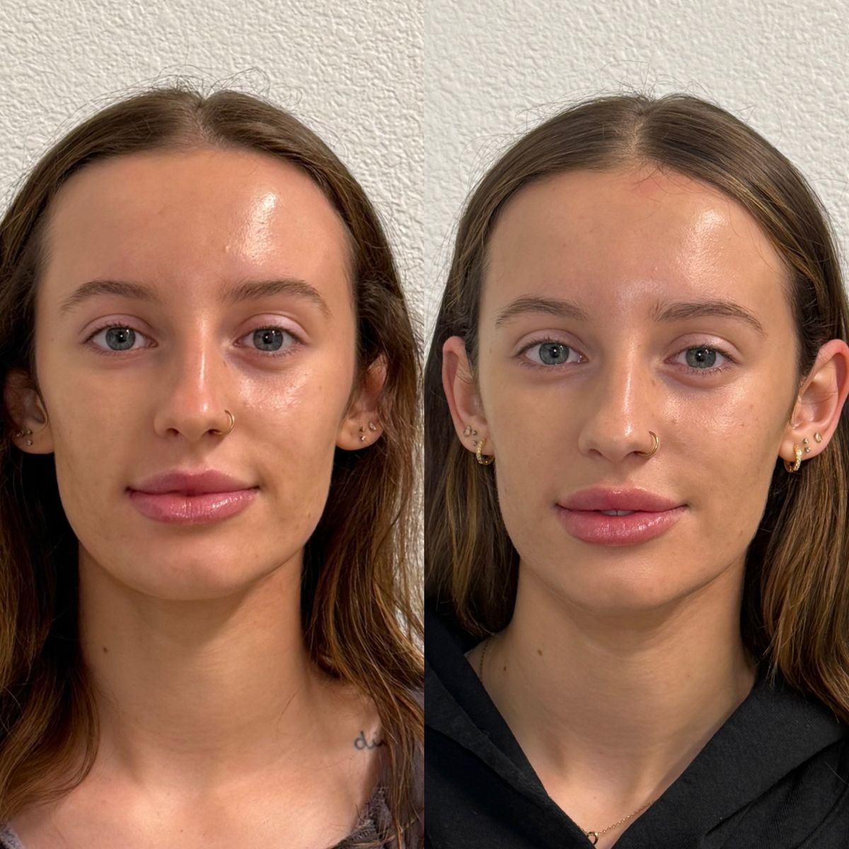 Before and after Lip Filler at Aster Aesthetics Salem Oregon