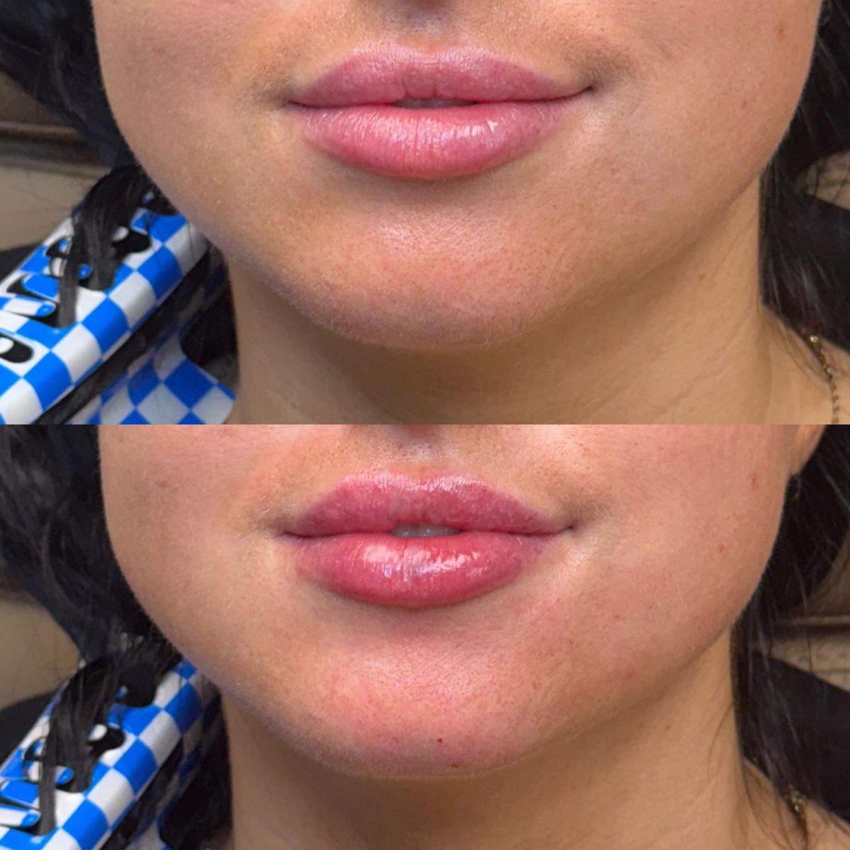 Before and after Dissolve & Refill at Aster Aesthetics Salem Oregon