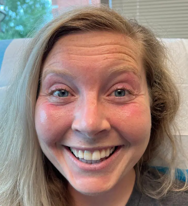 Before Botox Treatment