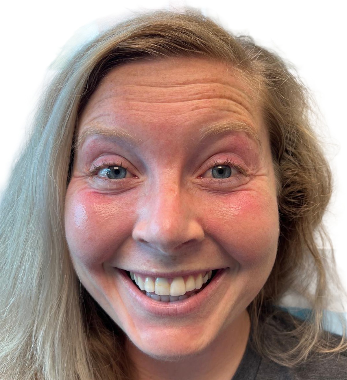 Before Treatment