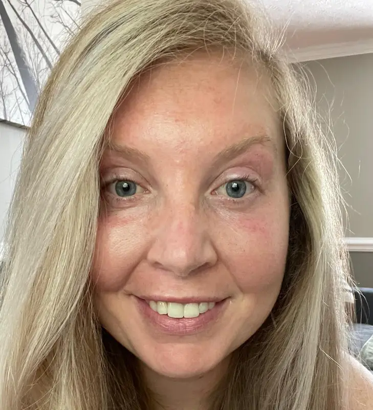 After Botox Treatment