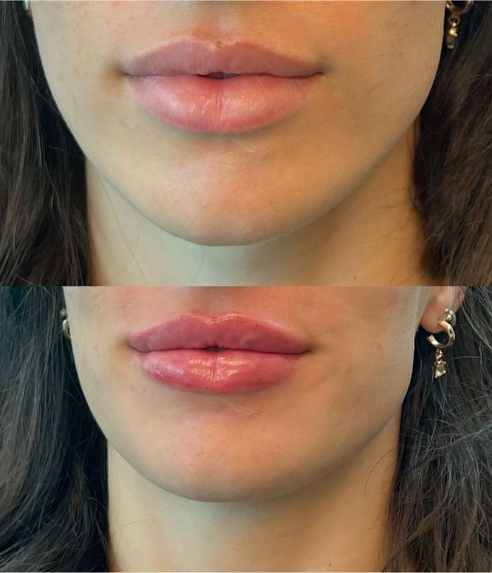 Aesthetic Lip Fillers
