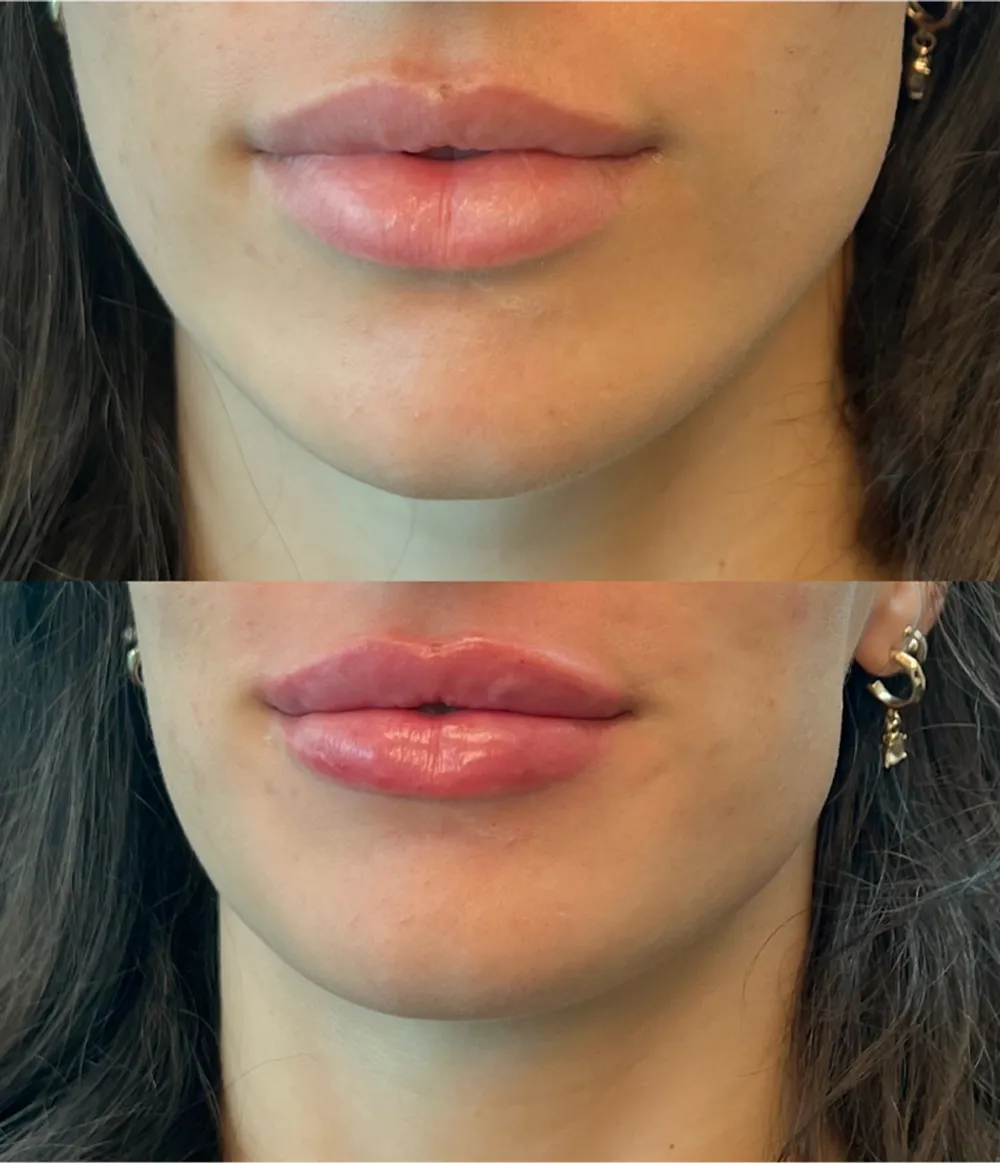 The Art of Lip Enhancement: Why Shape Matters More Than Size
