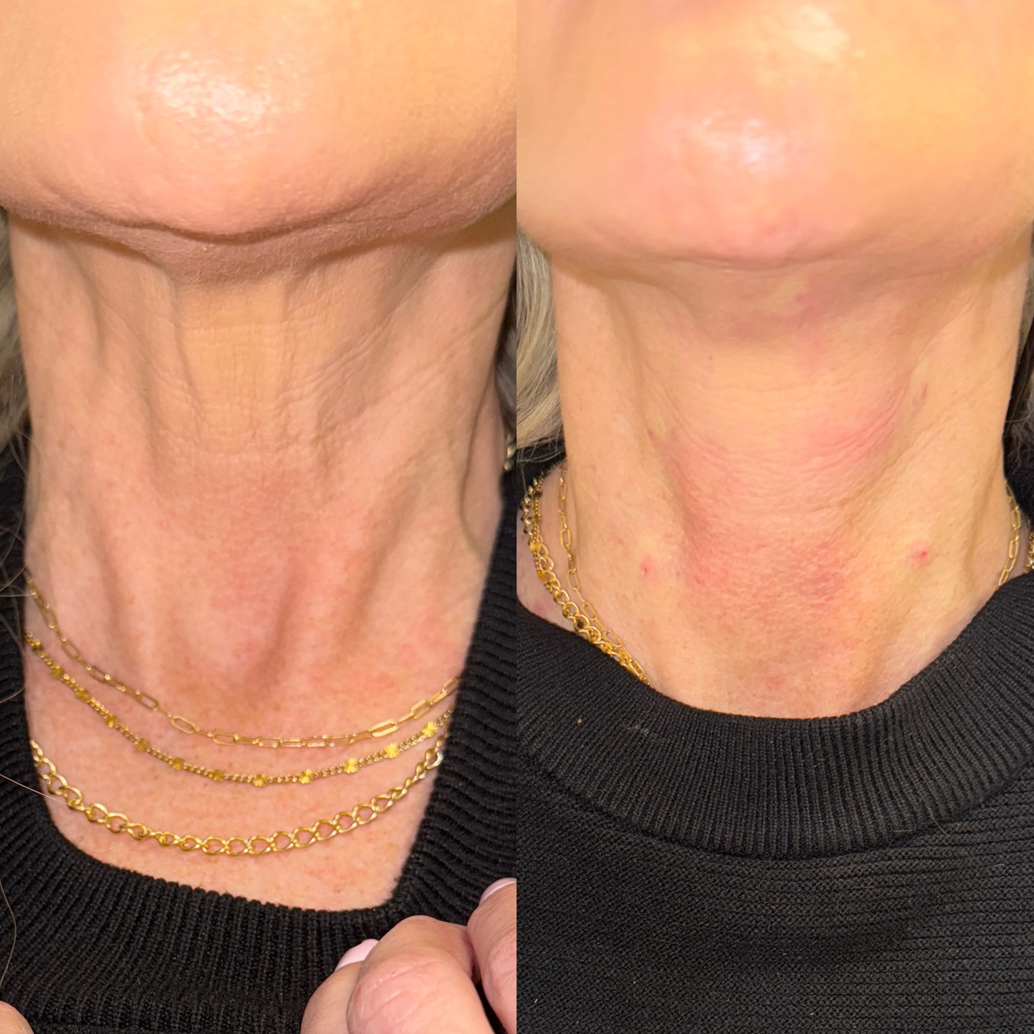 Say Goodbye to Crepey Neck Skin with Hyperdilute Radiesse