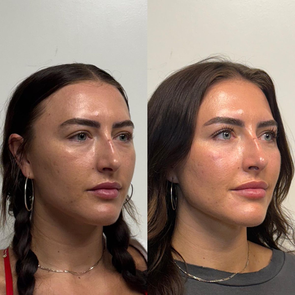 Before and after Facial Balancing — Healed Results at Aster Aesthetics Salem Oregon