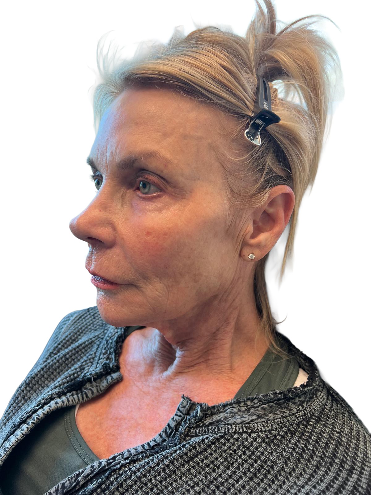 After Treatment