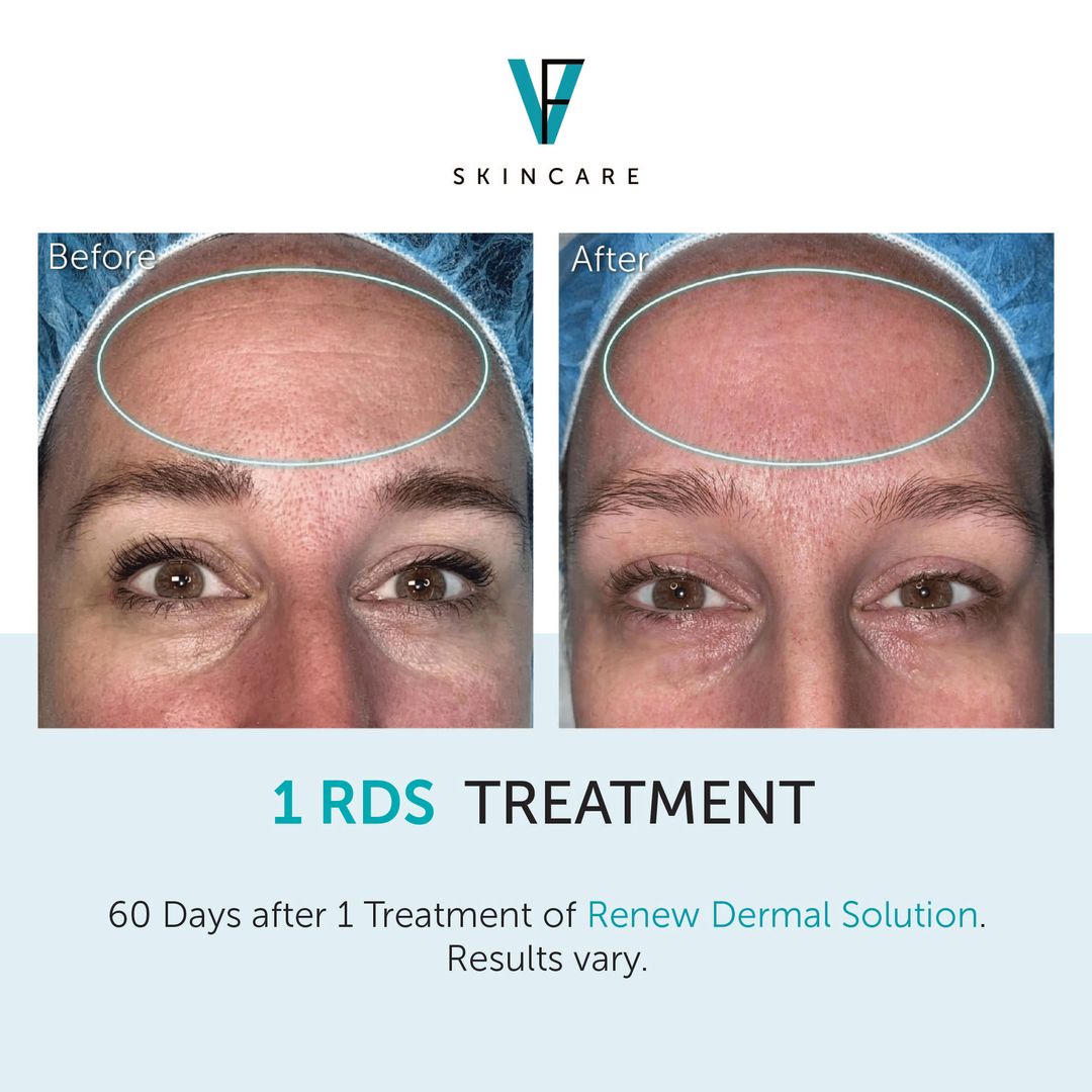 Rds B&a 1 Treatments 60 Days Brow.jpg