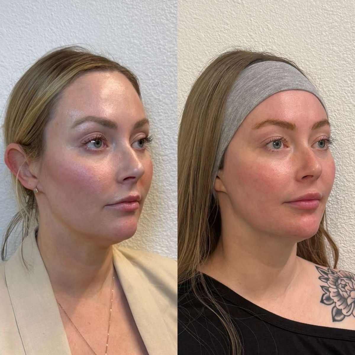 Before and after Facial Balancing Salem at Aster Aesthetics Salem Oregon