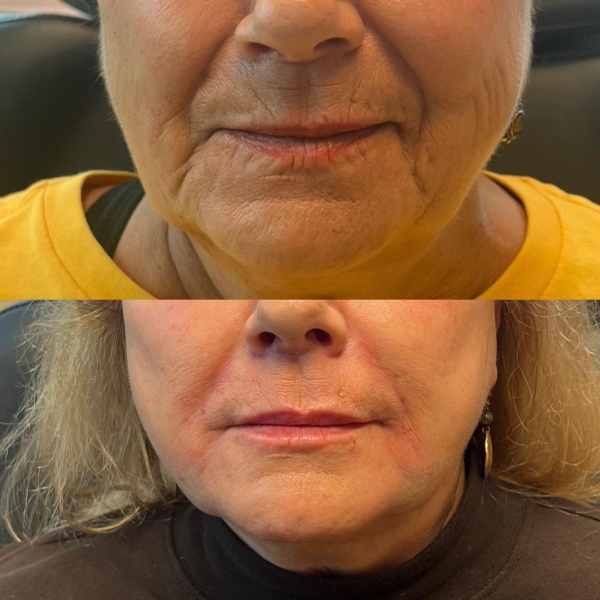 Before and after Nasolabial Folds, Marionette Lines, Chin Shadow & Lips at Aster Aesthetics Salem Oregon