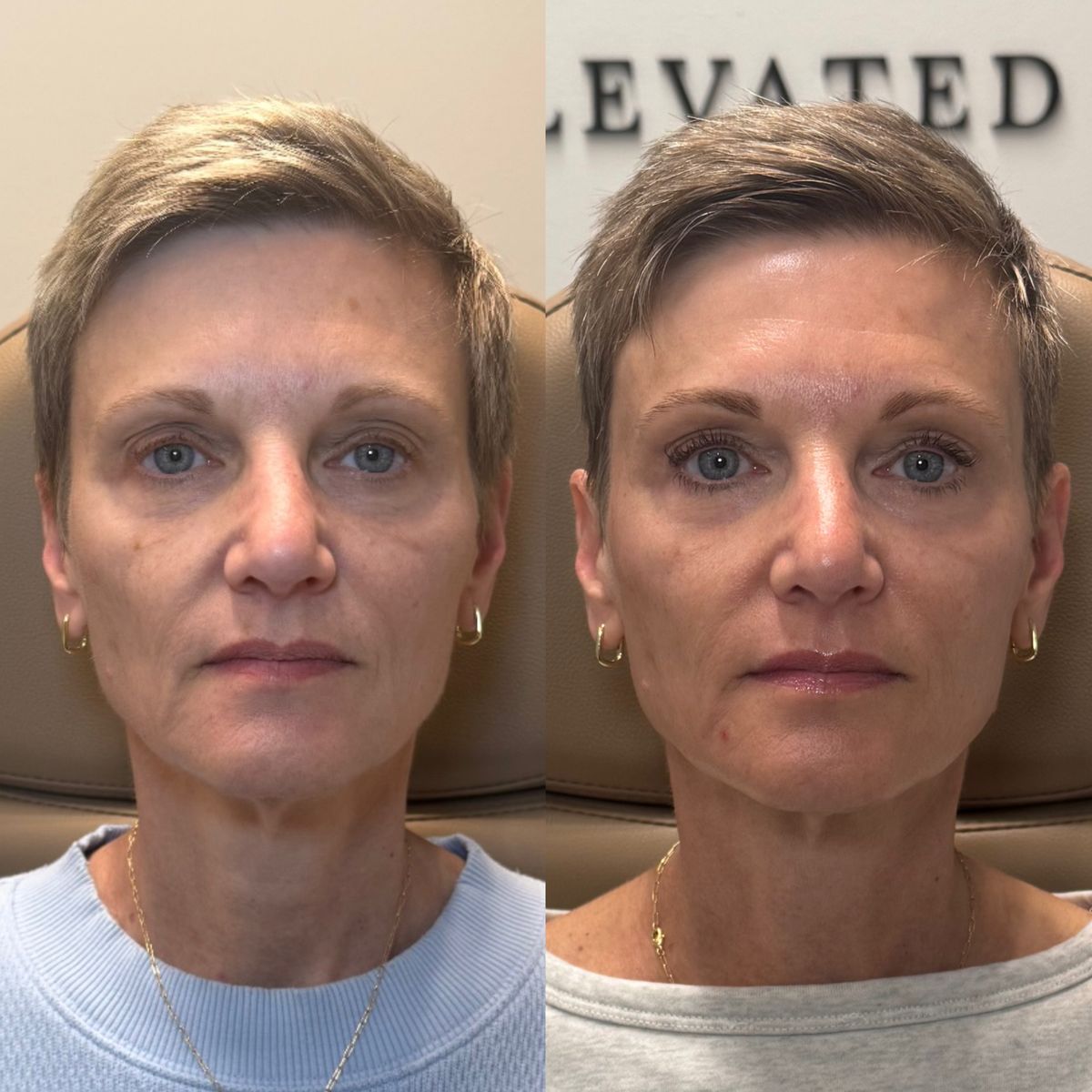 Before and after Before and After Laser Resurfacing at Aster Aesthetics Salem Oregon