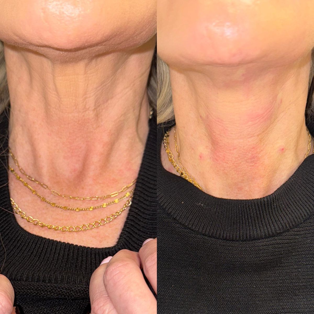 Before and after Hyperdilute Radiesse Neck Treatment at Aster Aesthetics Salem Oregon