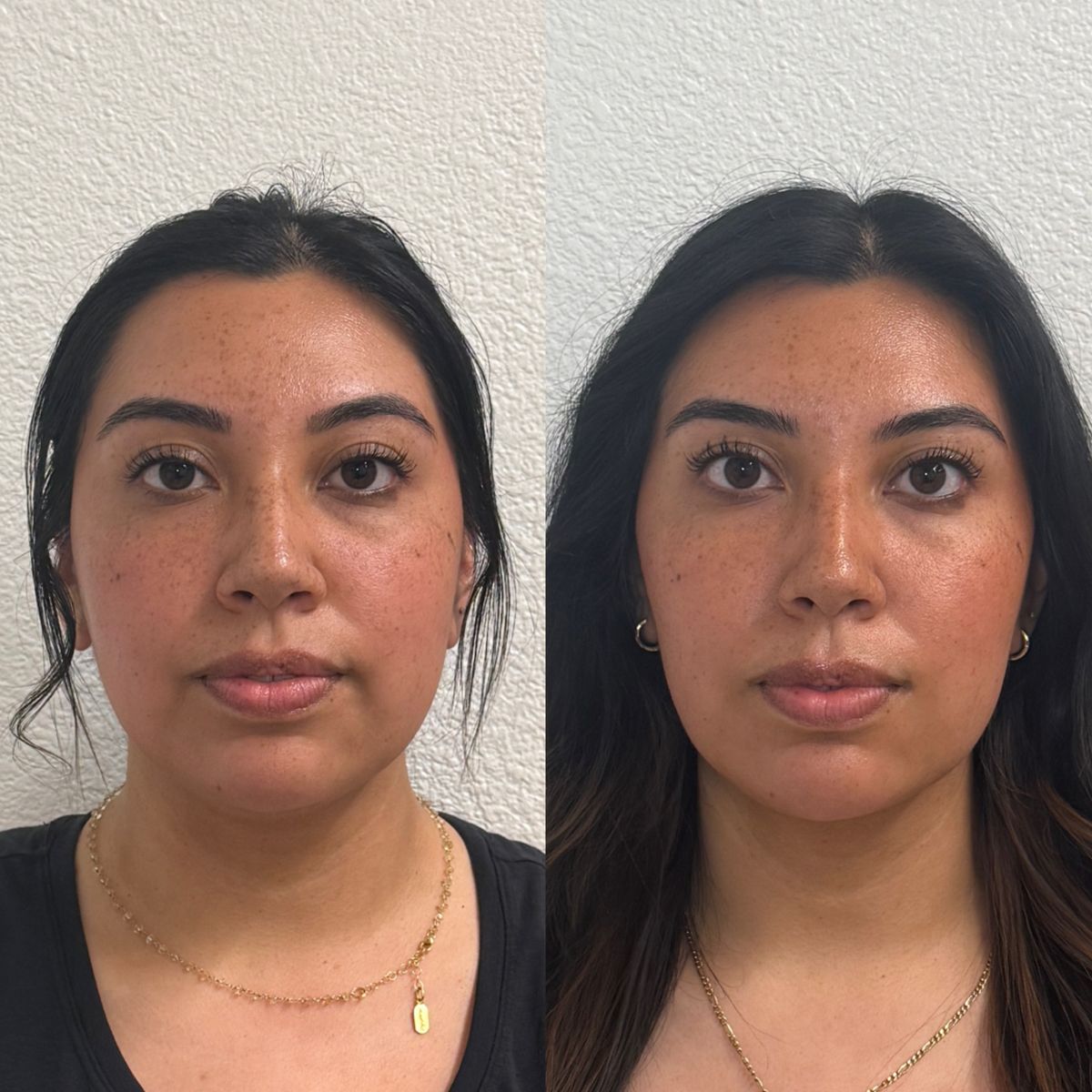 Before and after Facial Balancing at Aster Aesthetics Salem Oregon