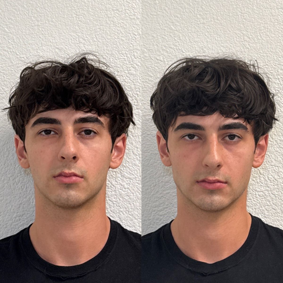 Before and after Facial Balancing at Aster Aesthetics Salem Oregon