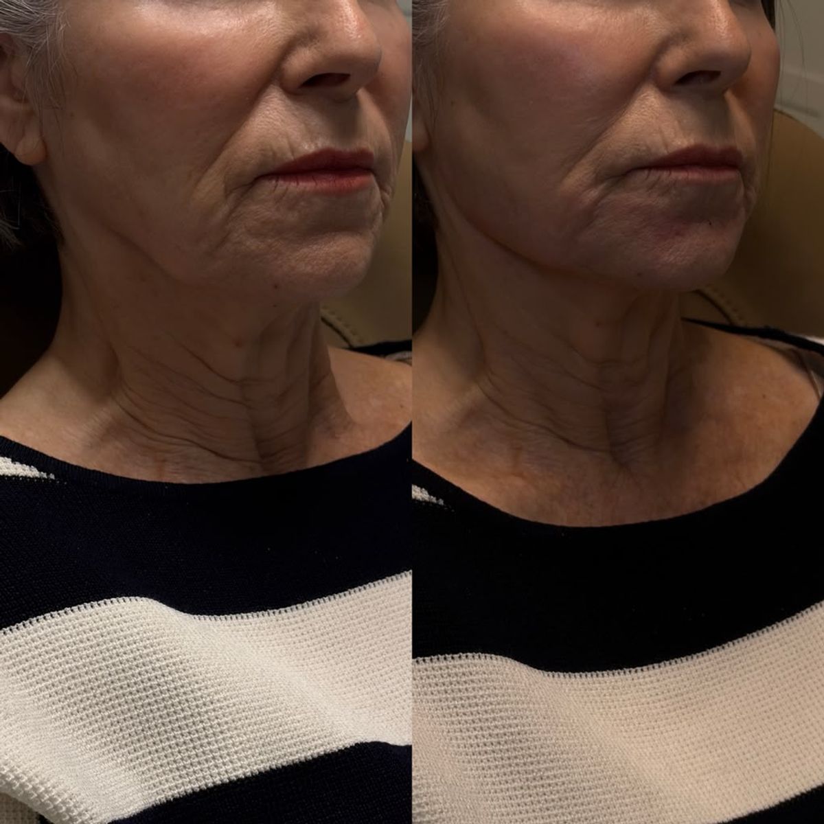 Before and after Comprehensive Lower Facial Balancing at Aster Aesthetics Salem Oregon