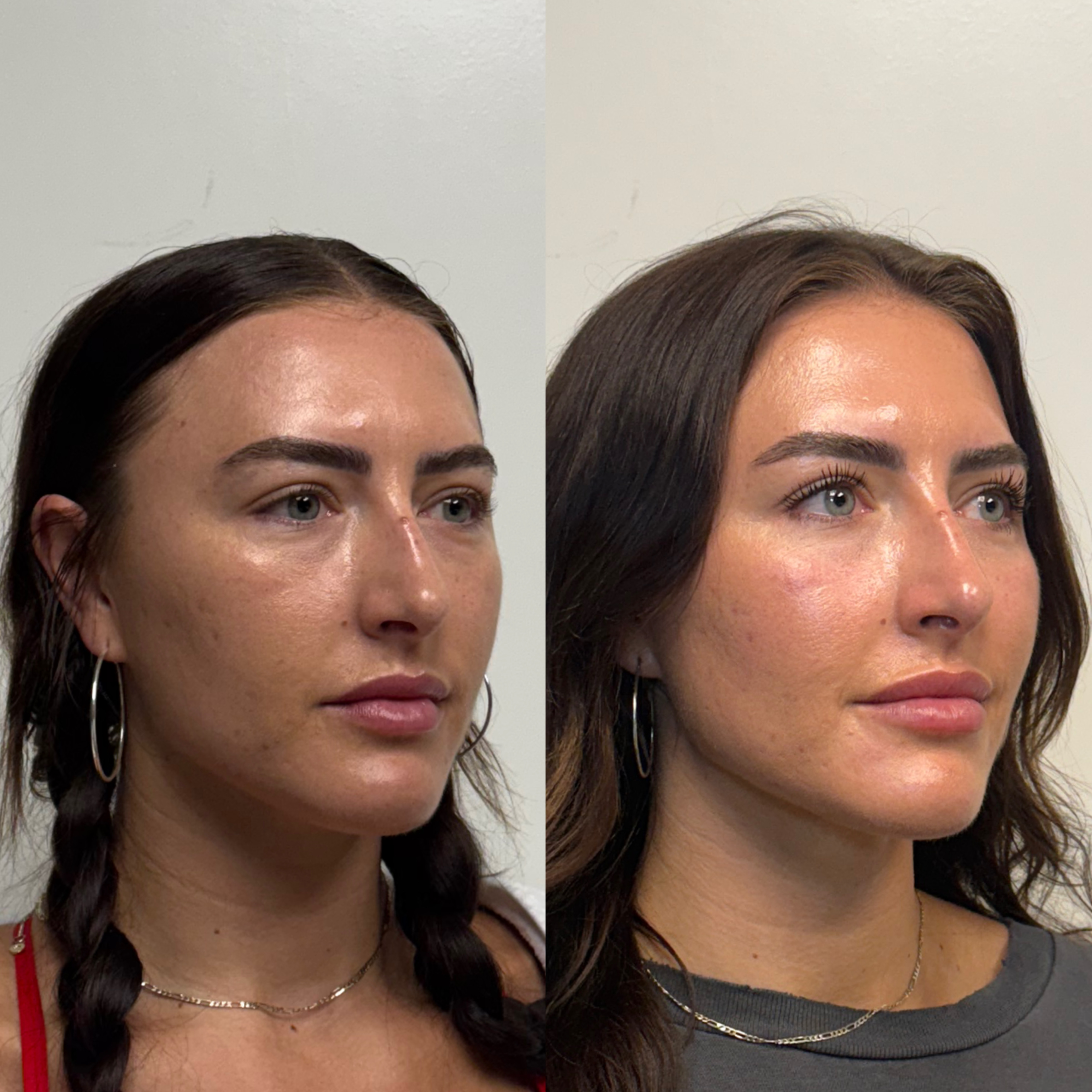 The Art of Undetectable Filler