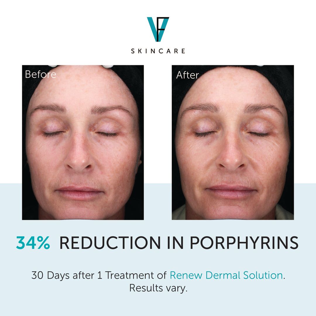 Rds B&a 1 Treatments 30 Days Porphyrins.jpg