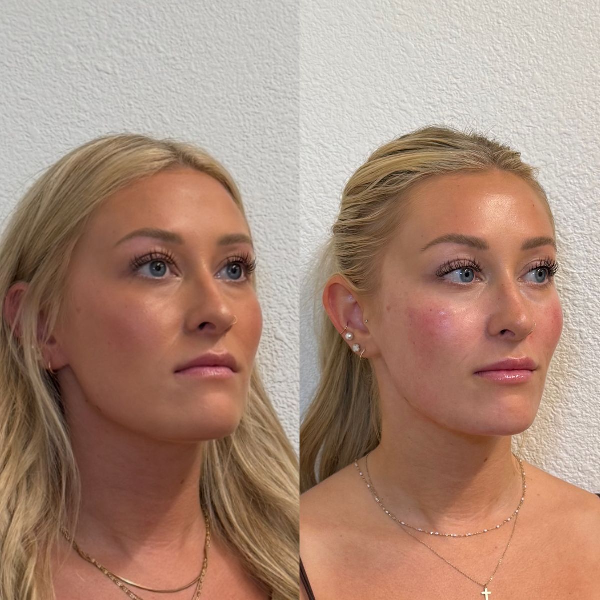 Before and after Immediately Before and After Facial Balancing at Aster Aesthetics Salem Oregon