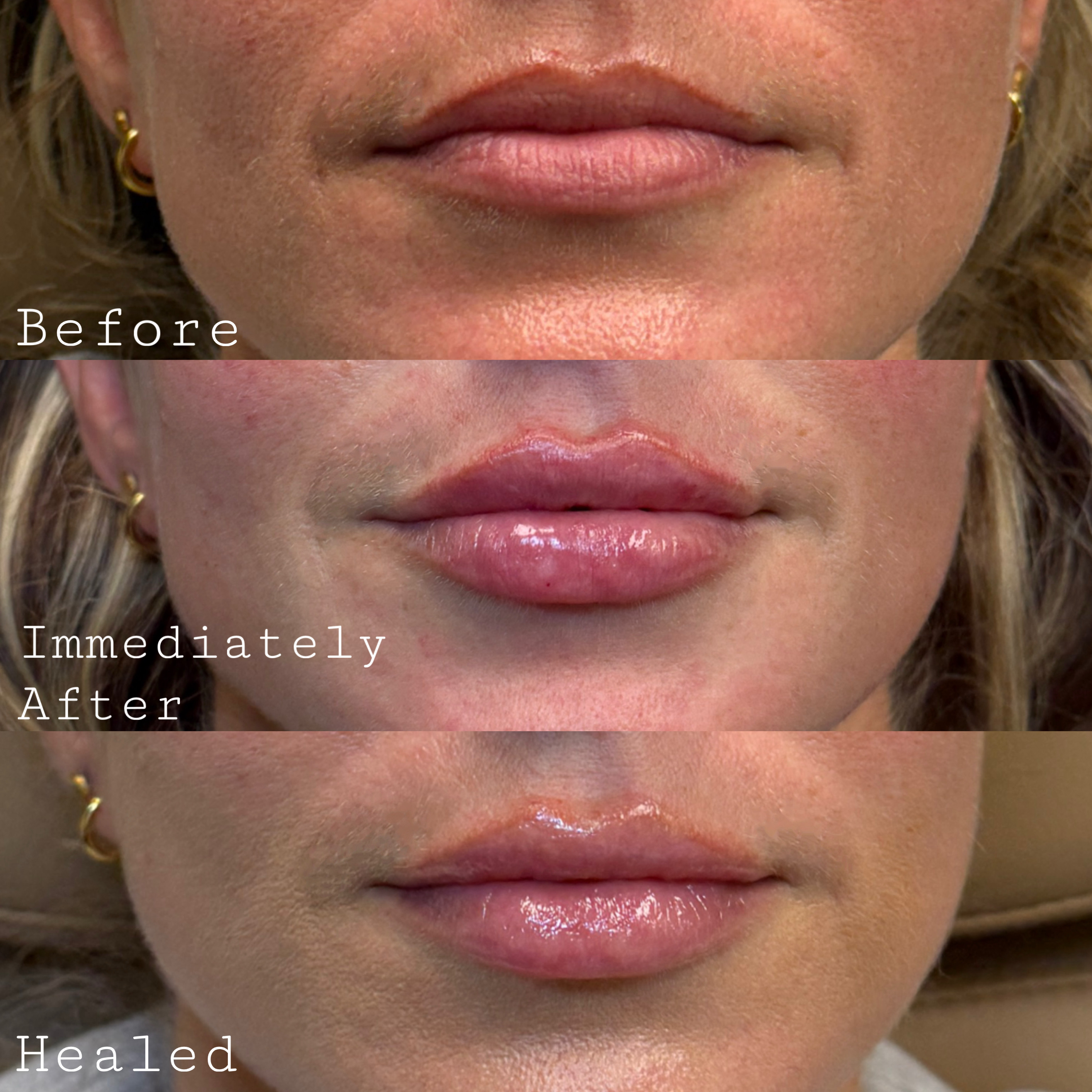 Before and After Isn’t the Whole Story: Why the Healed Result Matters Most in Lip Filler