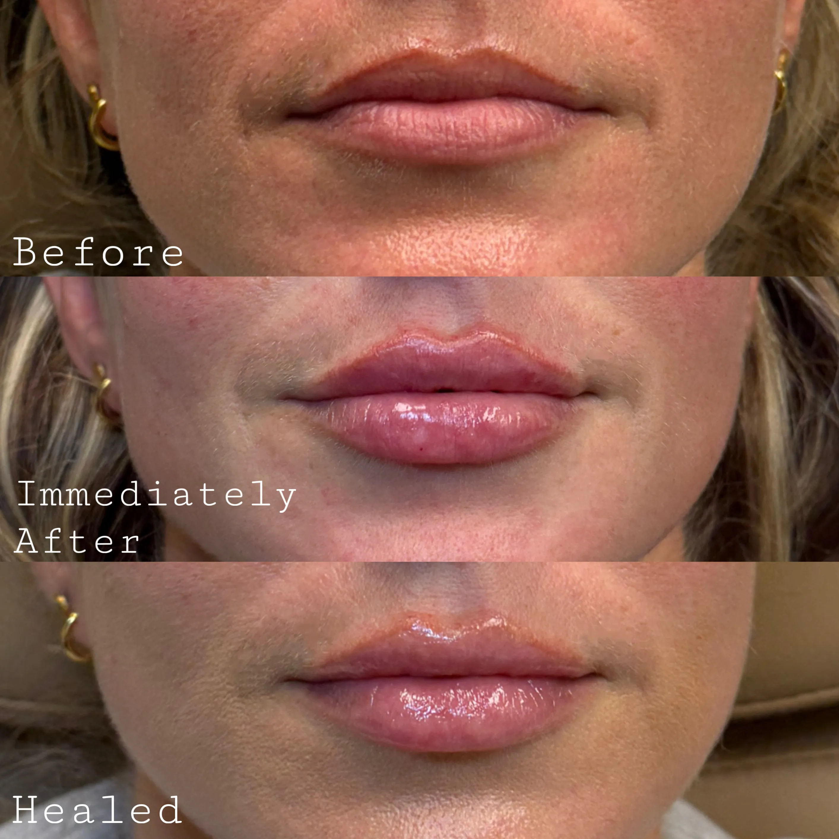 Before and After Isn’t the Whole Story: Why the Healed Result Matters Most in Lip Filler