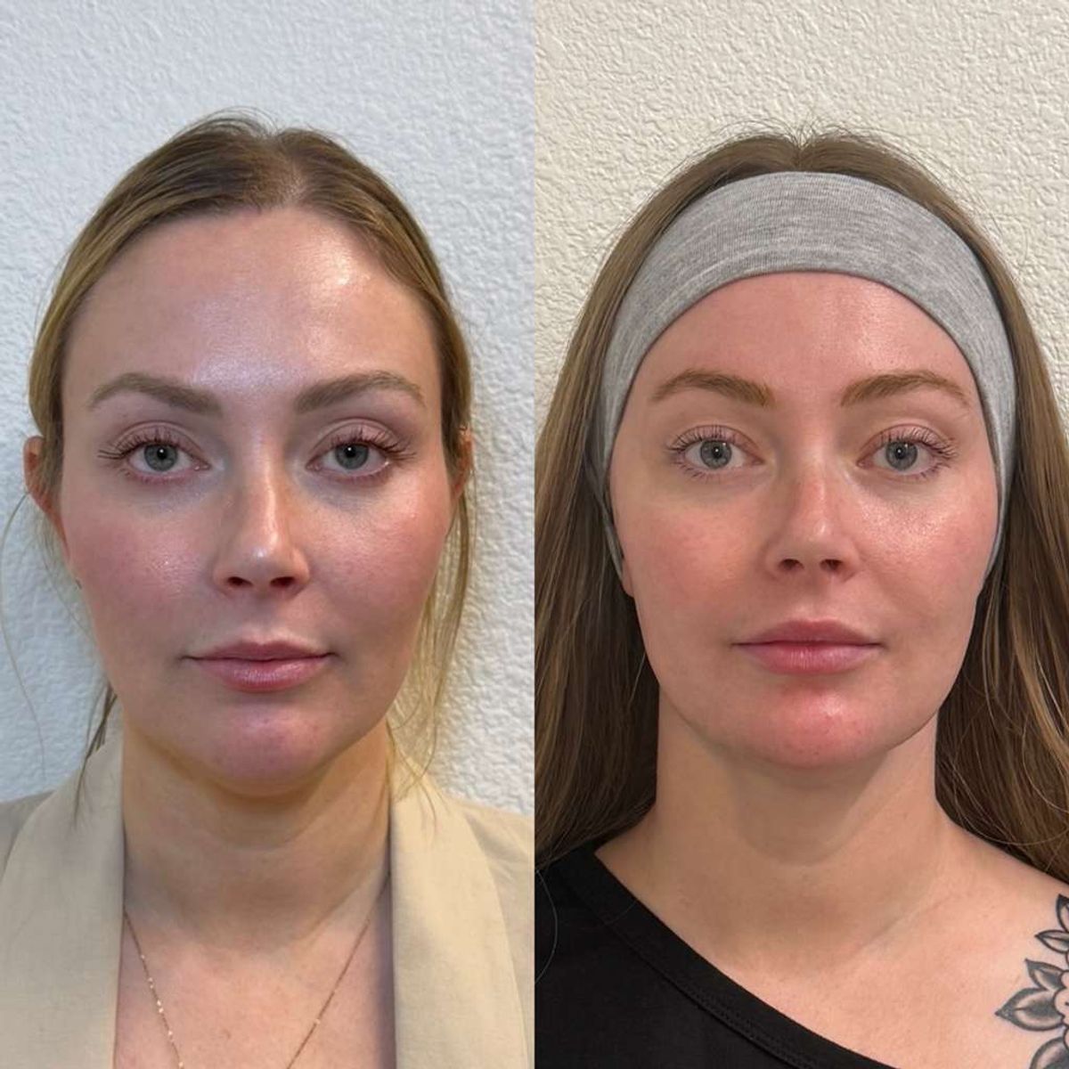Before and after Facial Balancing Salem at Aster Aesthetics Salem Oregon
