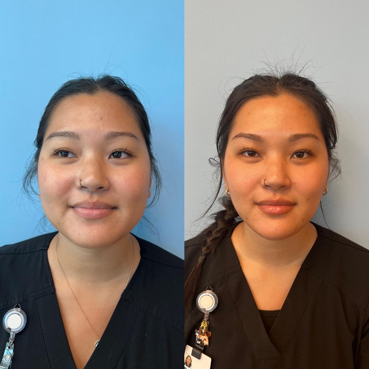 Before and after Full Facial Balancing — Botox, Masseter Reduction, Cheek, Chin & Lip Filler at Aster Aesthetics Salem Oregon