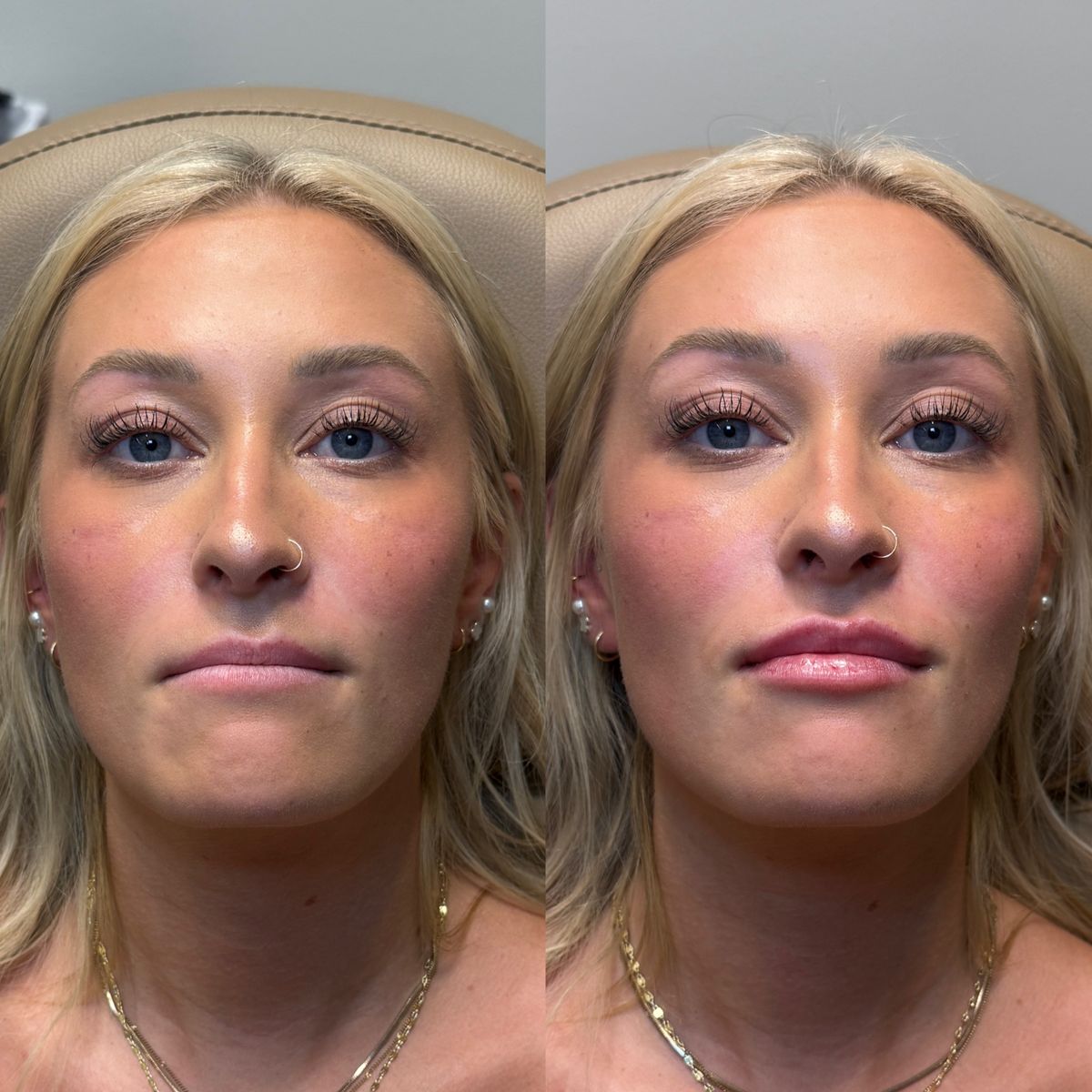 Before and after Before and After Lip Filler at Aster Aesthetics Salem Oregon