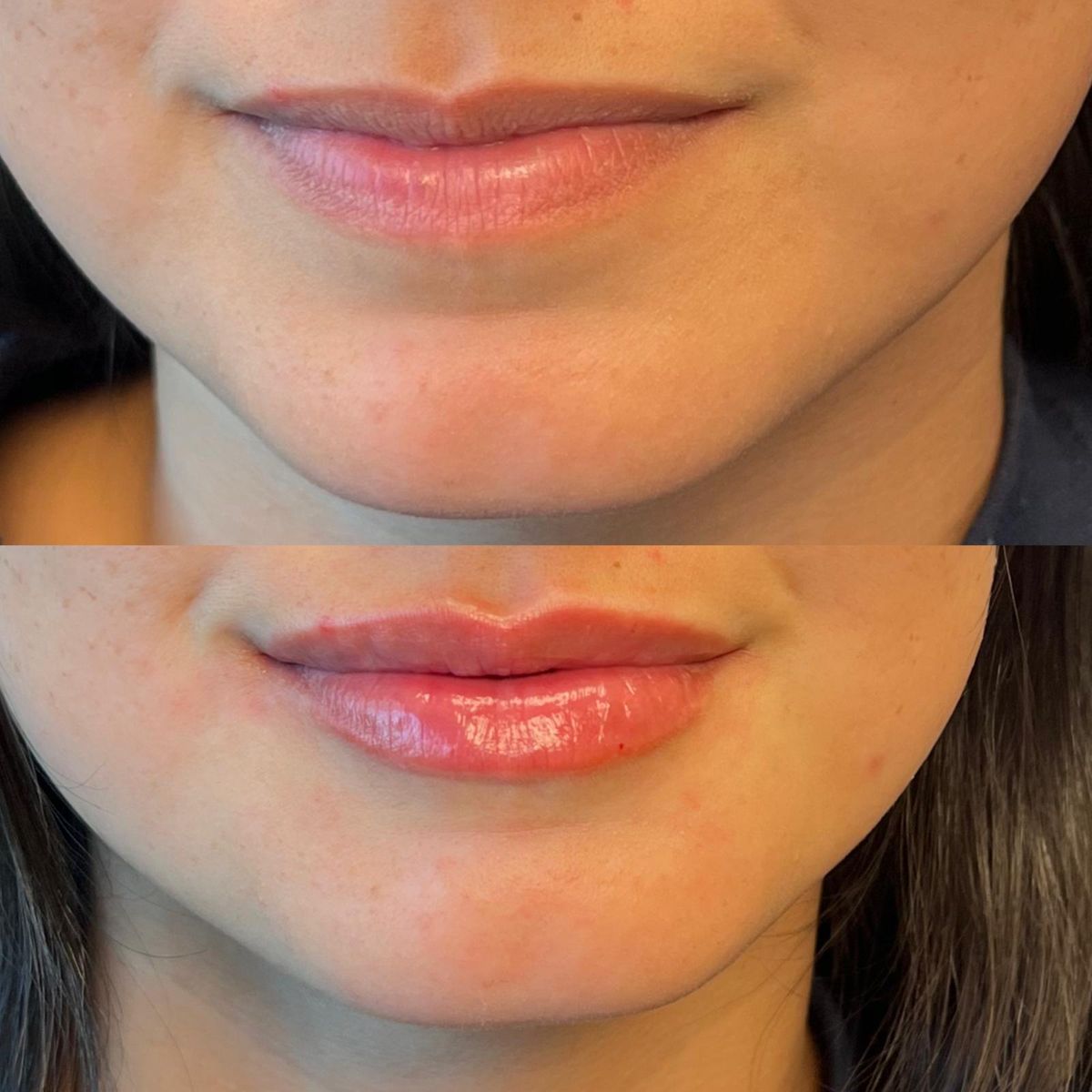 Before and after Lip Filler at Aster Aesthetics Salem Oregon