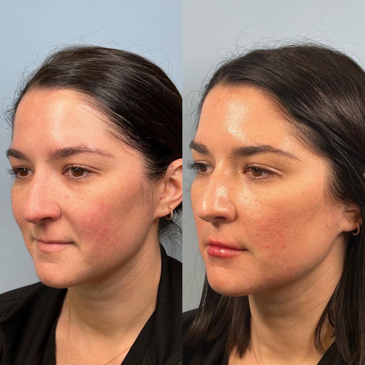 Before and after Facial Balancing — Lips, Cheek, Chin & Chin Shadow at Aster Aesthetics Salem Oregon