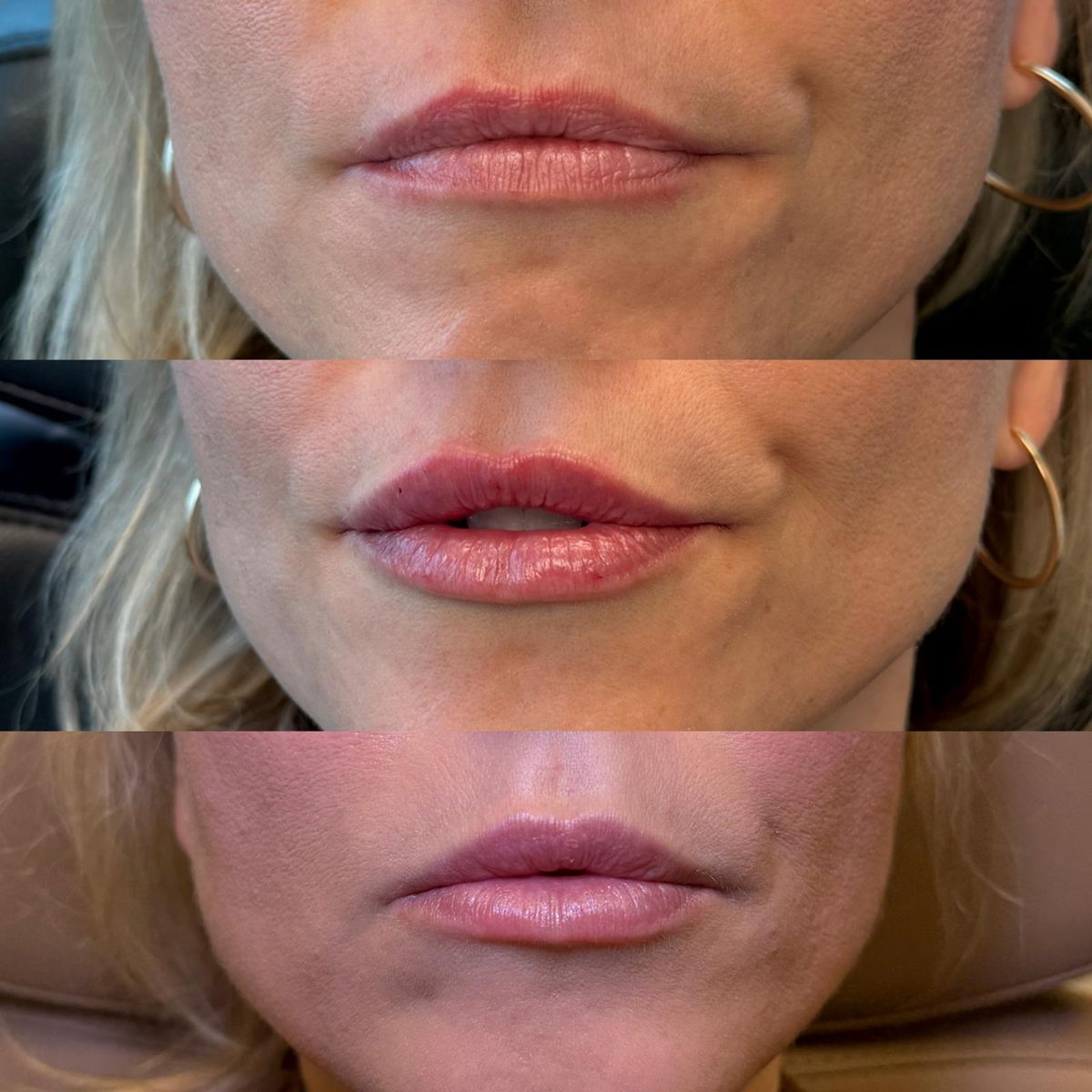 Before and after Lip Filler — Before, Immediately After & Healed at Aster Aesthetics Salem Oregon