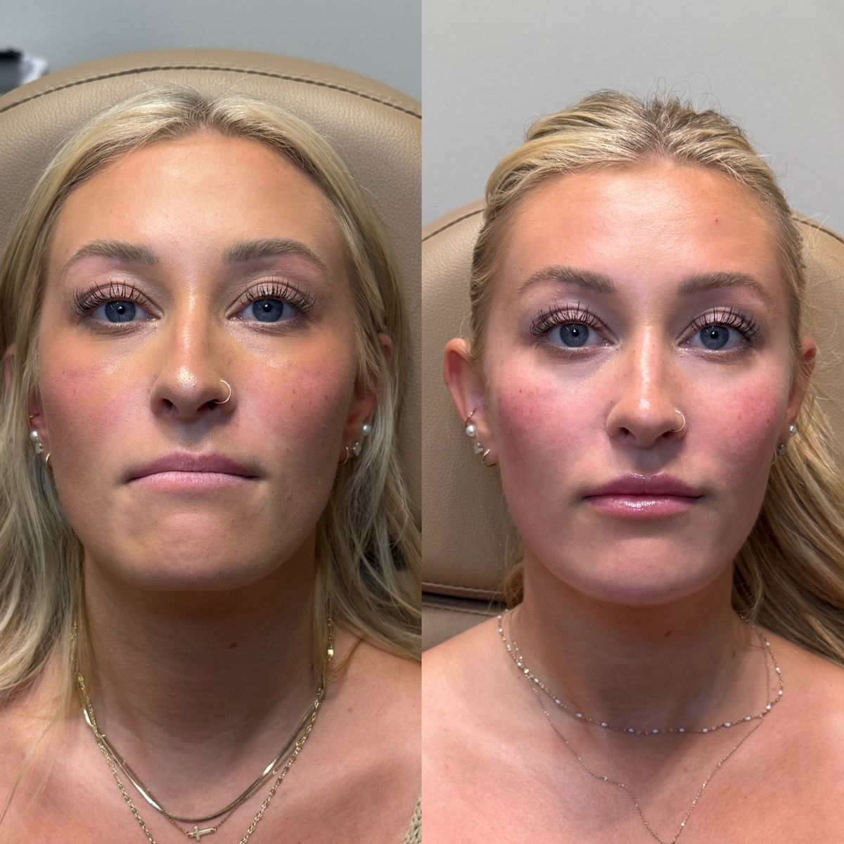 Before and after Immediately Before and After Facial Balancing at Aster Aesthetics Salem Oregon