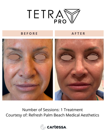 Tetra Pr O118175553142004