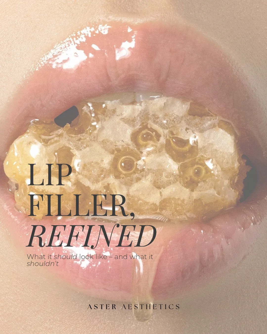 Why “Less” Is Often More in Lip Filler: A Modern Approach to Natural Results